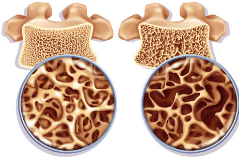 osteoporoz2