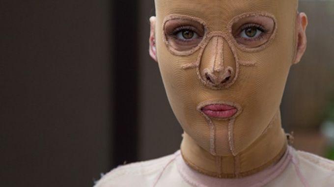 Жизнь без лица закончена: австралийка сняла маску, которую носила 2,5 года (18 фото)