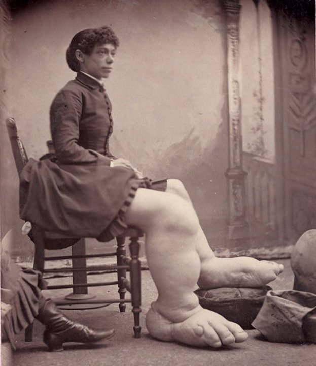 Женщина с большими ногами. «Цирк уродов»: Страшное зрелище (фото)