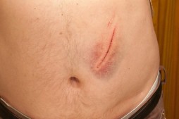 2010-09-25-belly-wound/