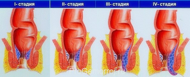 Геморрой имеет 4 стадии развития. Своевременно начатое лечение – гарантия выздоровления.