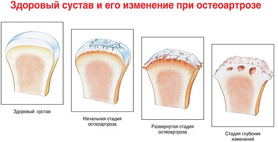 osteoarthritis