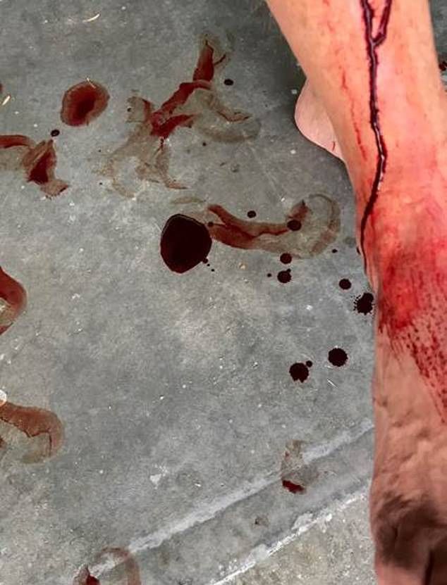 Взорвавшаяся бутылка пива покромсала мужика Взорвавшаяся бутылка пива покромсала мужика