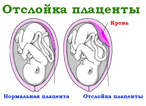 Как лечить гематому в матке во время беременности Как лечить гематому в матке во время беременности