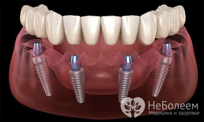 Имплантация зубов All-on-4: основные преимущества 