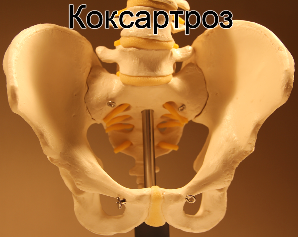 koksartroz tazobedrennogo sustava