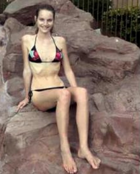 Эта девушка в течение 8 месяцев ела лишь 3 яблока в день. И вот к чему это привело... Эта девушка в течение 8 месяцев ела лишь 3 яблока в день. И вот к чему это привело...