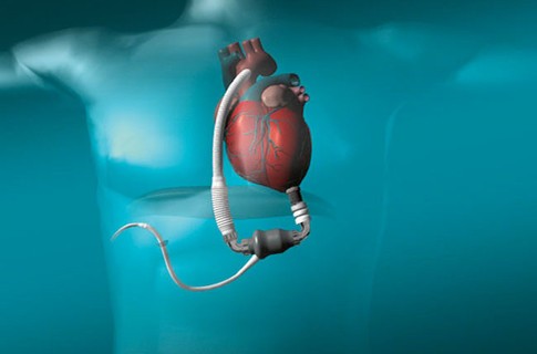 Ученые испытали прототип беспроводного искусственного сердца | Наука и Технологии | СЕГОДНЯ