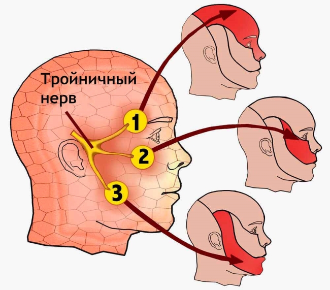 Почему воспаляется тройничный нерв Почему воспаляется тройничный нерв
