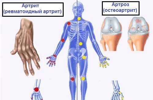 Разница между артрозом, артритом и остеопорозом