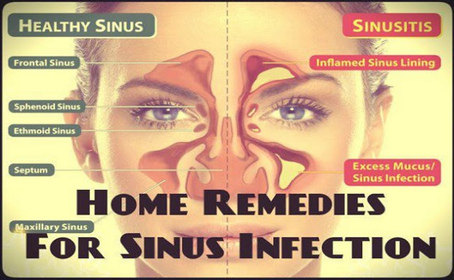 The Best Home Remedies For Sinus Infection – Relief Without Antibiotics Лучшее средство для лечения синусита без антибиотиков