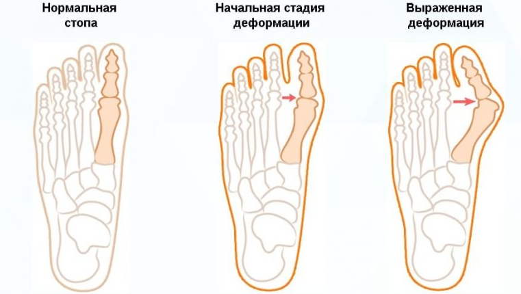Симптомы подагры: современные методы и способы лечения