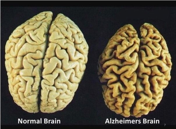 Сравните мозг обычного человека и мозг больного деменцией - само собой напрашивается выражение 
