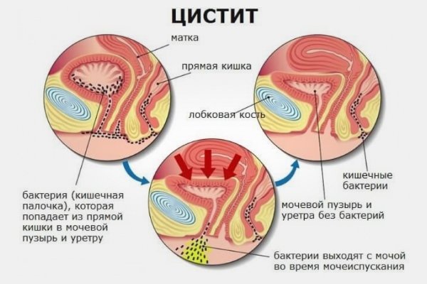 Цистит у женщин