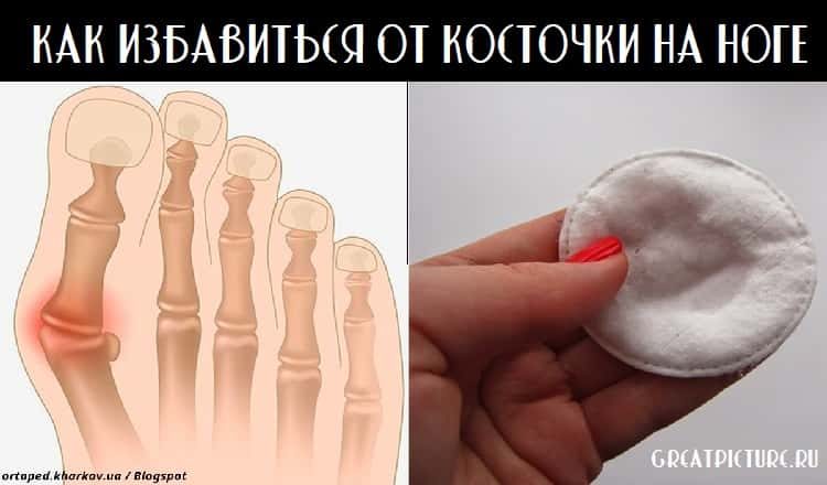 Медсестра рассказала, как избавиться от косточки на ноге. Работает!