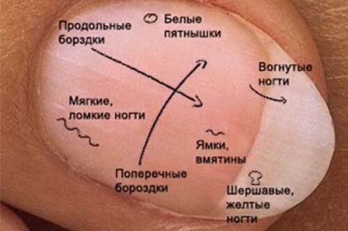 Признаки болезней, или Как определить болезнь по ногтям