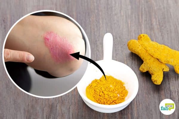 intro-turmeric-for-psoriasis-600x400