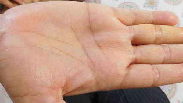 7 опасных болезней, которые можно определить по состоянию рук