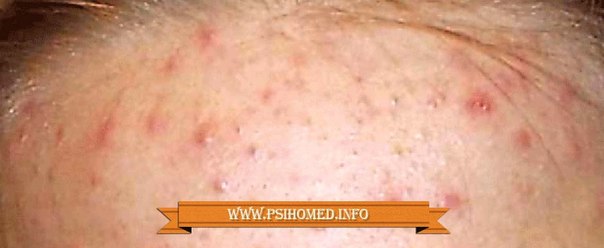 Могут ли из-за кофе появится прыщи Могут ли из-за кофе появится прыщи