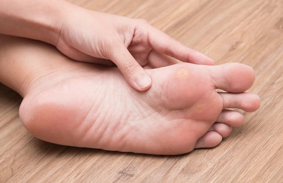 Стержневая мозоль: чем отличается от обычной и как избавиться своими силами