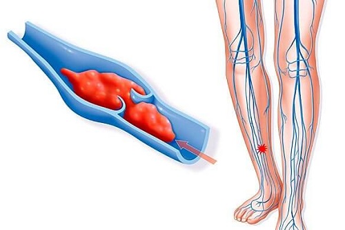 Тромбоз глубоких вен: 8 симптомов, сигнализирующих об опасности