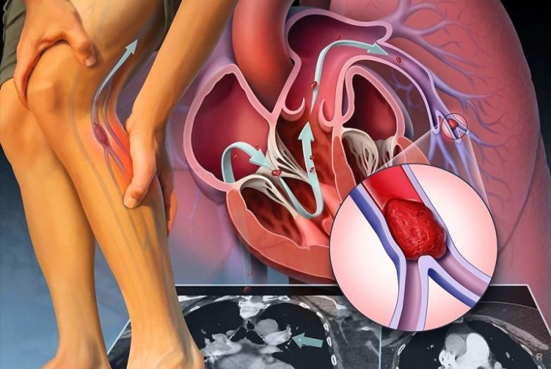 Эти симптомы указывают, если тромб в организме