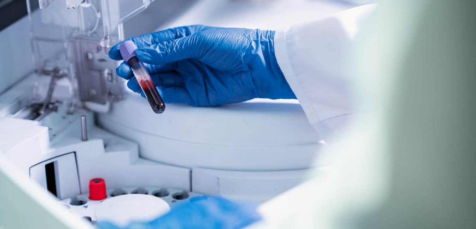 Ожирение может ускорить прогрессирование болезни Альцгеймера