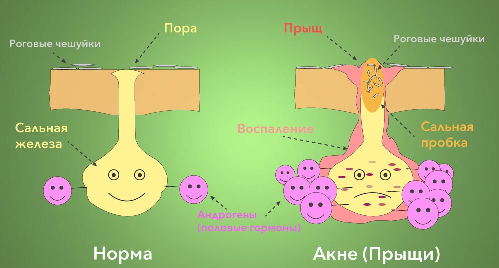 Прыщи