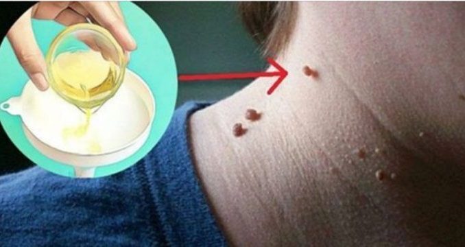 Как избавиться от сделанного самостоятельно 881