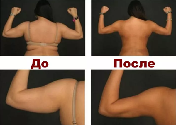 Как подтянуть обвисшие руки? Красивая форма без пластики!