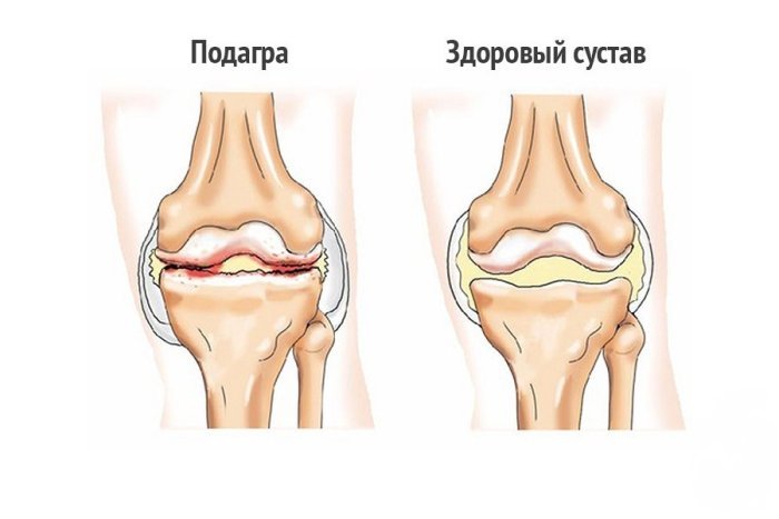Подагра. Диета при подагре. Народные методы лечения подагры Подагра. Диета при подагре. Народные методы лечения подагры