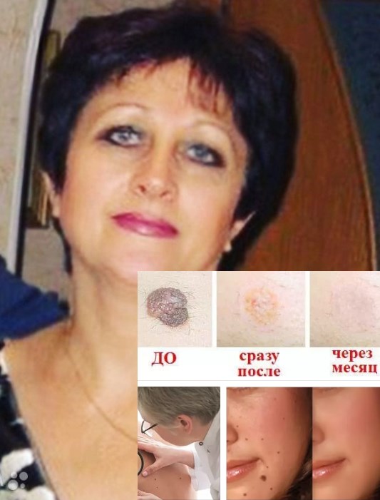 ochen neploho kvd udalenie rayona frunzenskogo v papillom ploho interesno tolko Удаление папиллом в квд фрунзенского района фото