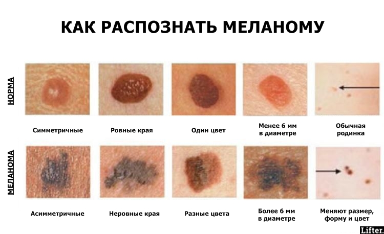 Серое шершавое пятно на коже Серое шершавое пятно на коже
