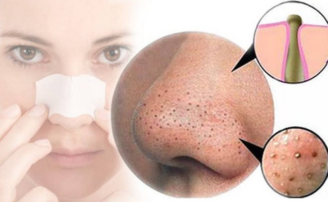 Get Rid of Blackheads With These 4 Natural Home Remedies!