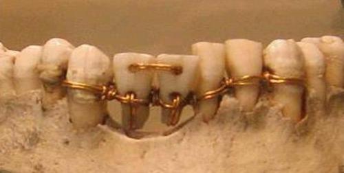 http://www.vavident.com/userfiles/image/forarticles/ag_tooth_zoom.jpg