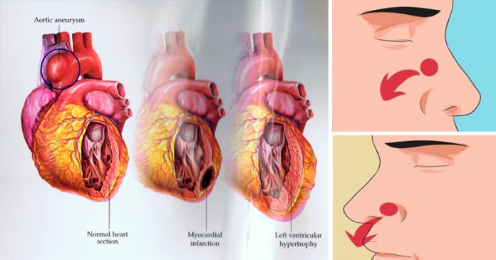 9 опасных признаков высокого артериального давления, которые мы игнорируем!