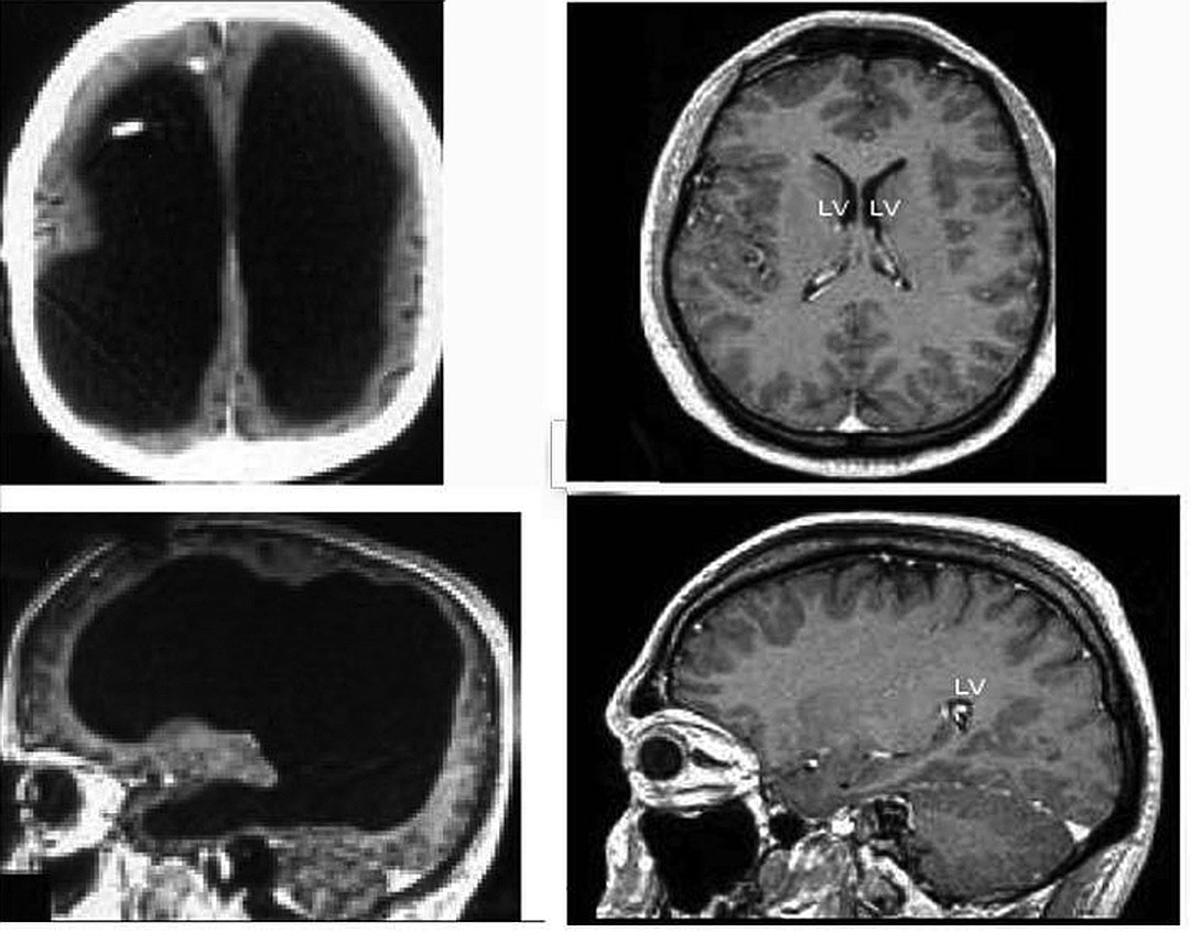 Мужчина с жидкостью вместо мозга (левые снимки), справа нормальное строение мозга. 