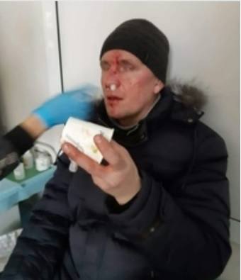 На острове Татышев в Красноярске мужчина получил сотрясение мозга и сломал нос
