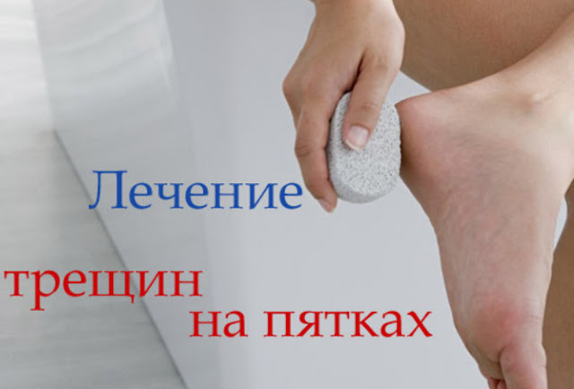 Народное лечение трещин на пятках в домашних условиях Народное лечение трещин на пятках в домашних условиях