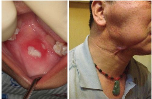 0-Symptoms-for-Oral-Cancer.-Who-Is-at-Risk-e1474313284554