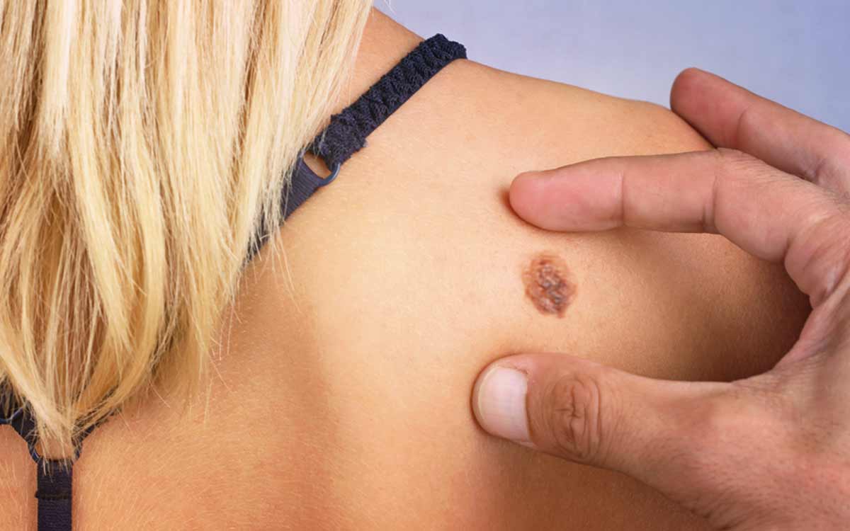 7 Симптомов Рака Кожи Люди Должны Обратить Внимание