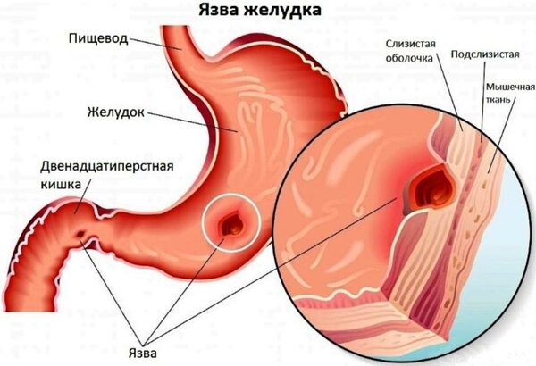 Одно из противопоказаний - язва желудка и двенадцатиперстной кишки