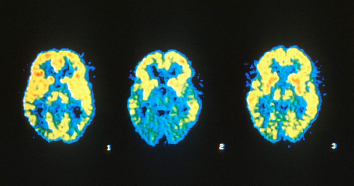 9-habits-you-need-to-start-today-to-stop-dementia-and-Alzheimer’s-before-it-starts