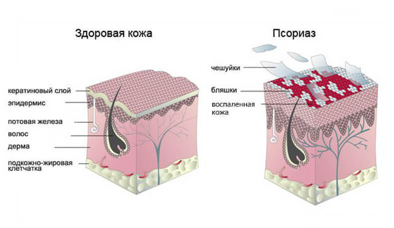 Что такое псориаз