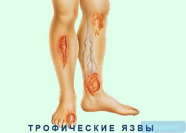 Чем лечат трофические язвы на ногах в домашних условиях Чем лечат трофические язвы на ногах в домашних условиях