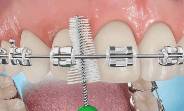 Брекеты зло? Есть ли что-то правдивое в словах «экспертов из интернета»