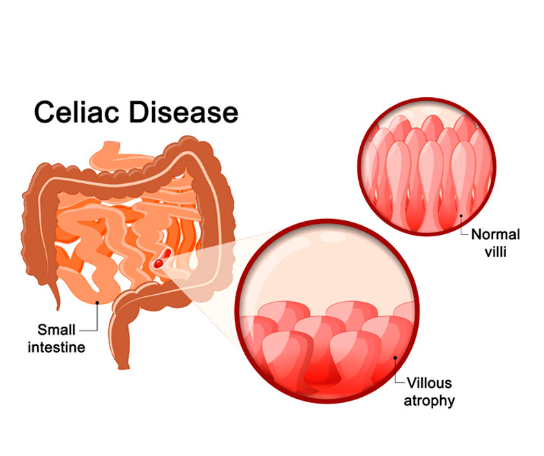 Чем целиакия отличается от непереносимости глютена