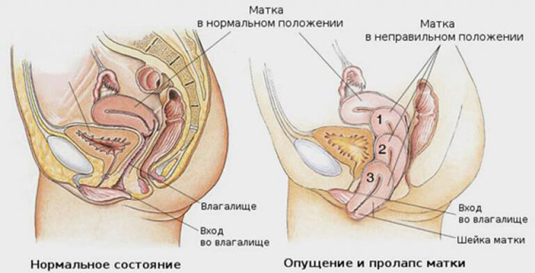 Опущение матки и органов малого таза: 5 упражнений, которые помогут Опущение матки и органов малого таза: 5 упражнений, которые помогут