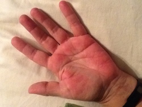 7 опасных болезней, которые можно определить по состоянию рук