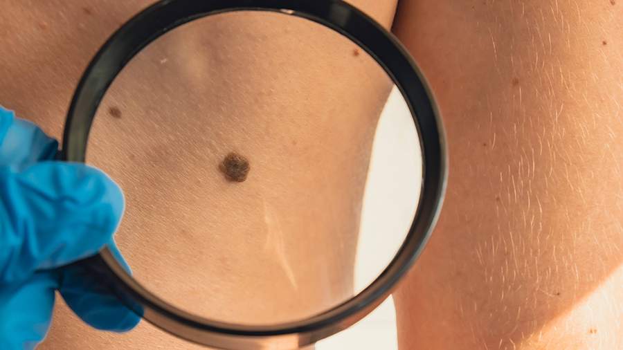 Онколог перечислил категории людей в группе риска меланомы